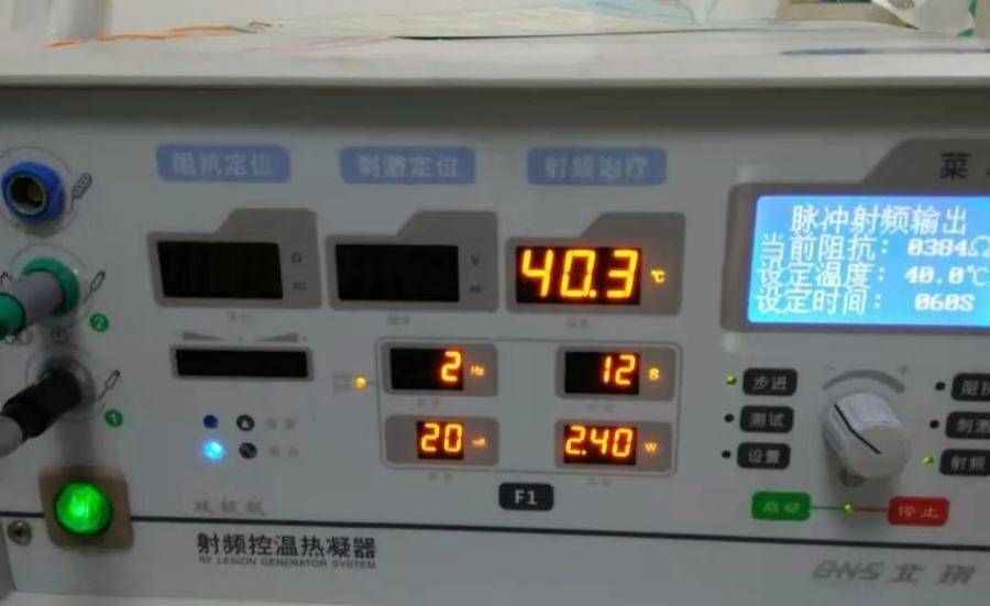 Rehabilitation Pain Department of Binyi Yantai Affiliated Hospital: Radiofrequency Neuromodulation for Postherpetic Neuralgia