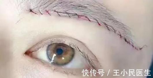 教授|王小民教授:眼周衰老,提眉与切眉哪个更适合你呢?