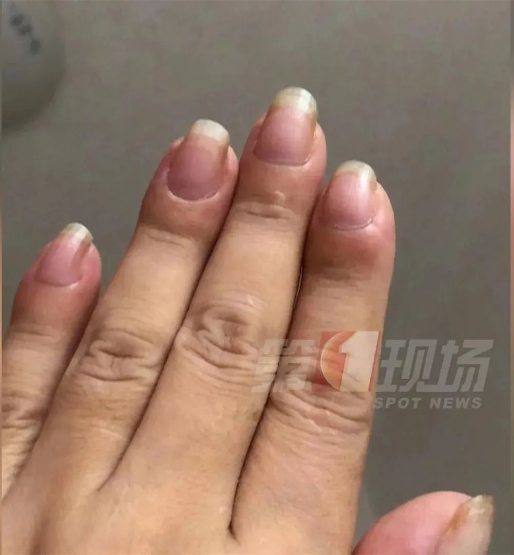 江女士|女子手指肿成“萝卜头”，一查竟是肺癌！警惕身体发出的这些信号