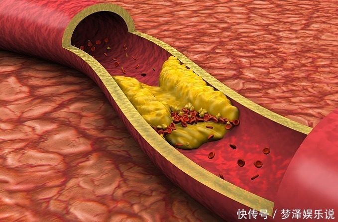 血管|甘油三酯“天敌”找到了，洋葱靠边站，若你爱吃，血管通透