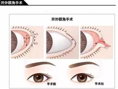 听说10个开内眼角，9个留疤？眼角还敢开吗？