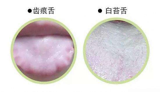 舌体|舌头有齿痕,就是有湿气这是误解,请不要再传播了