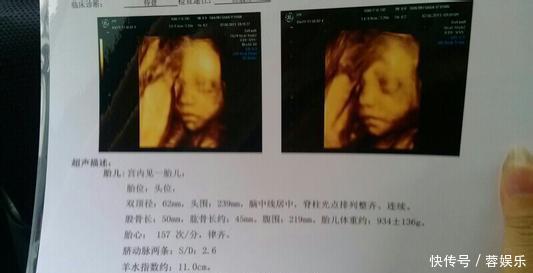 胎儿|这是孕妈容易吃亏的产检,也是复查率较高的产检