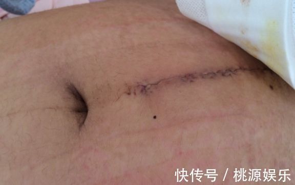 孕妇们|剖腹产到底会对女性产生哪些“副作用”大夫说出了实情,别大意