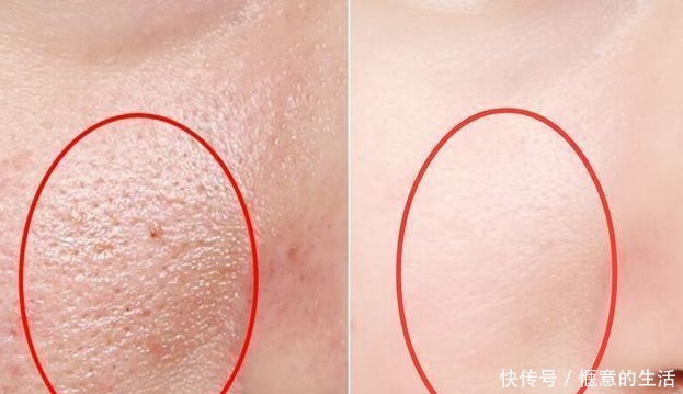 氨基酸洗面奶|先别慌着挤黑头,这3种原因你知道了再挤也不迟!