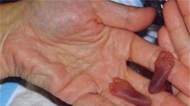 拇指姑娘|童话里的“拇指姑娘”走进现实,一出生仅25厘米,如今美出泡儿