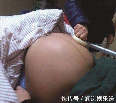 三胞胎|产妇怀上畸形3胞胎,却拒绝引产,现如今的生活令人羡慕不已