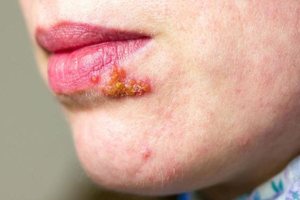 口腔溃疡|嘴上经常长泡,是怎么回事可能是这4种疾病的“信号”,别忽视