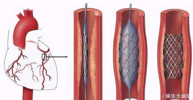 心脏支架进口、国产怎么选才合适？