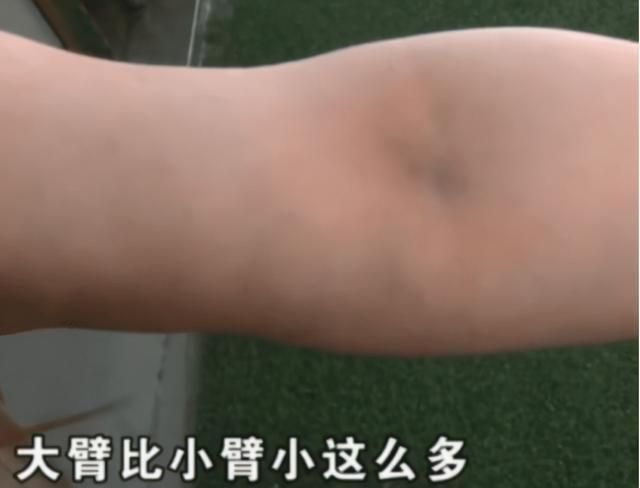 假体 女生花6万整容,手术失败脸上要挂着注射器,医院:赔给你一万三