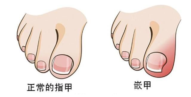 矫形鞋|宝宝的鞋子怎么买、怎么穿这几点一定要知道