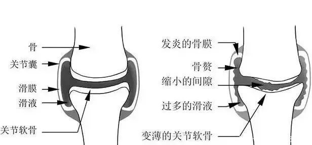 牛膝|奶奶膝盖疼下楼难，乡下70岁阿妈给了一秘方，7天膝关节炎消了！