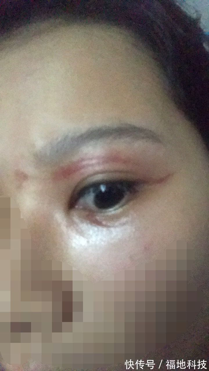 男孩|6岁男孩只因惹了这个小家伙脸部皮肤溃烂。麻烦就在“举手之间”