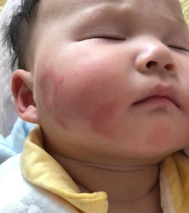 异食癖|还在抱怨孩子缺锌难发现吗？或是因为你没留意到这些