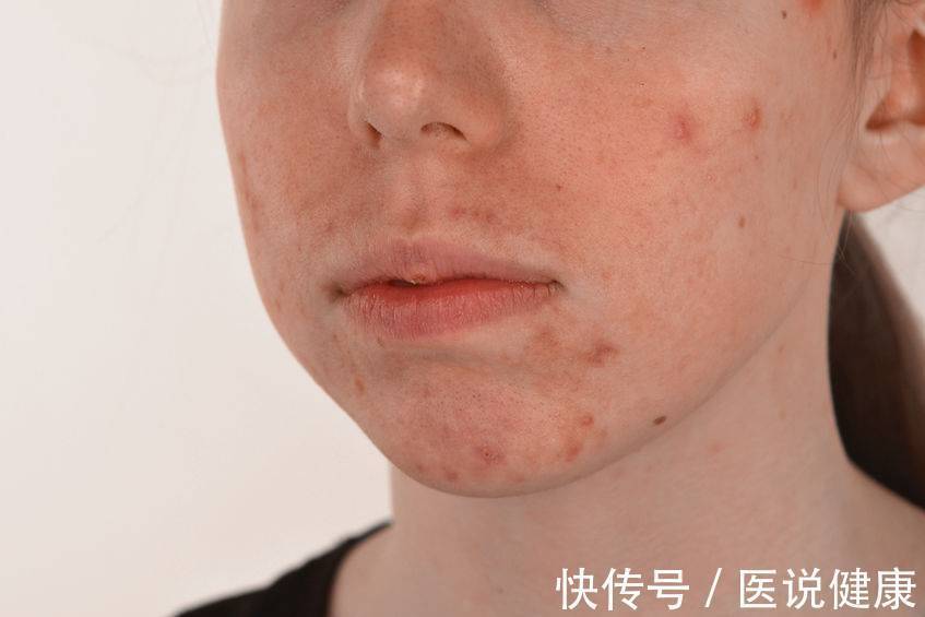 面部|脸上反复长痘,或与这4个因素有关,找到诱因后,需针对治疗