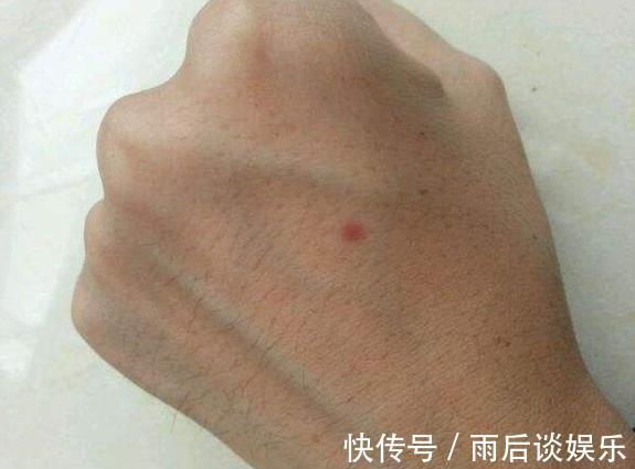 hpv|不要错把艾滋当成皮肤病，这些情况如果出现，可能就是艾滋的信号