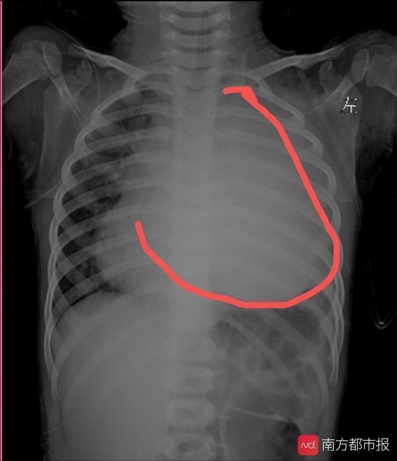 良性瘤|【南方都市报】庞大良性瘤长在了三岁孩子的高危区域 团队出战成功卸除