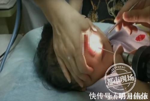 异物|4岁女童鼻里塞珠子,妈妈竟自己掏,险些要了孩子的命