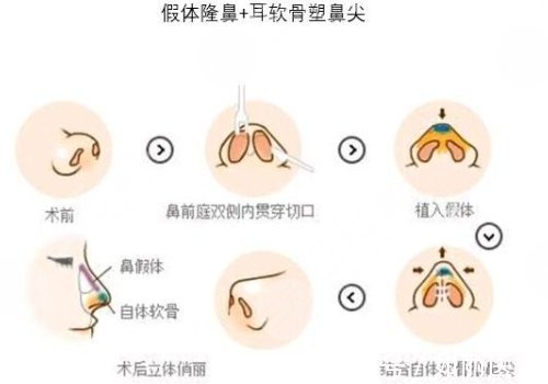 攻略 美鼻攻略|耳软骨隆鼻恢复期多久?注意事项+术后护理盘点!