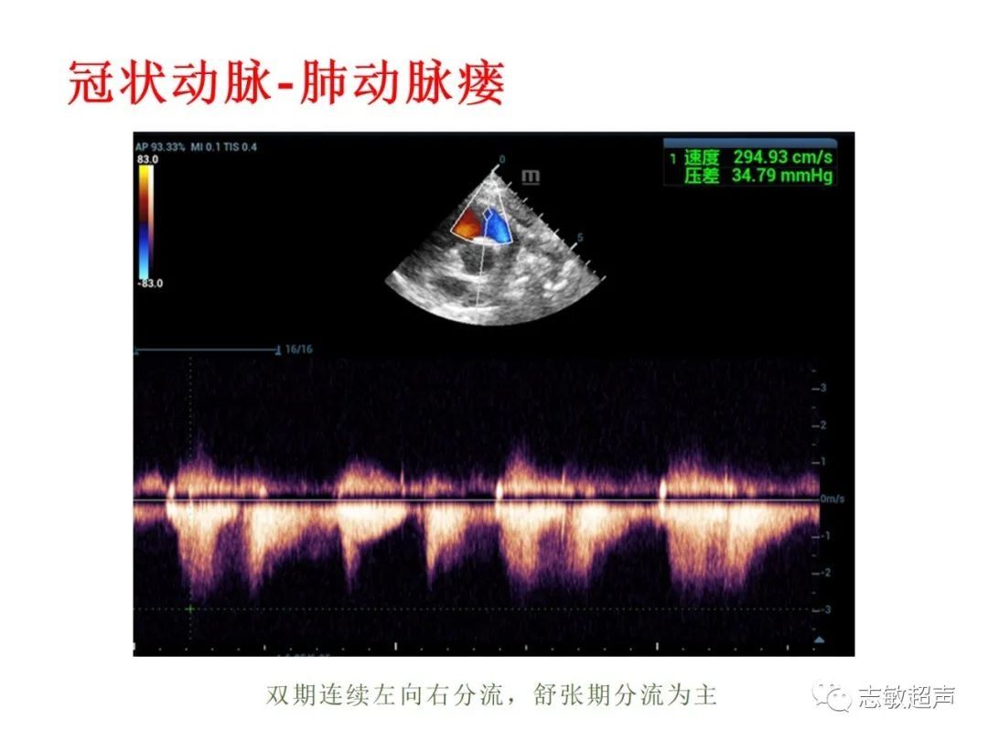 超声|肺动脉瓣周边异常血流的超声鉴别