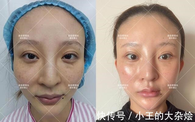 面部 做过3次线雕的她,为什么还要跑来做拉皮手术!
