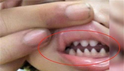 口腔|孩子长了一口“鲨鱼牙”,妈妈着急送医,医生:无知害了孩子