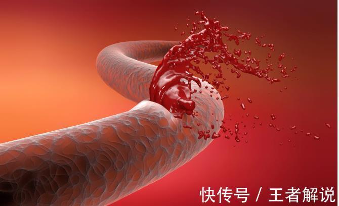 开颅手术|本以为是感冒，却诊断为脑出血，一周后去世！脑出血发生有何症状