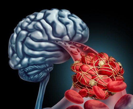 头晕|脑供血不足需重视,经常头晕、头痛要注意,正确预防治疗才正确