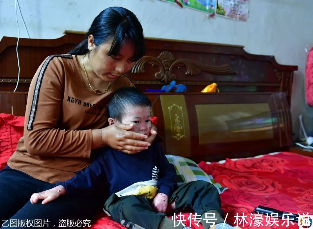 纱布|男童出生患罕见病,三年用掉纱布5000多圈,每天只能坐在床上