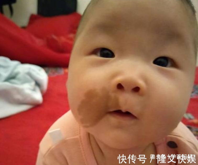 血管瘤|越来越多胎儿被“胎记”缠身,若不想孩子自卑,孕妈要管住自己