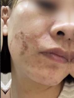 女子花近3万整容换回二度烫伤，医美医院：正常不良反应