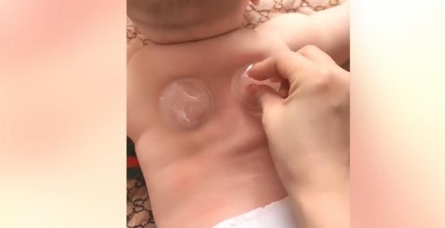 妈妈|妈妈用吃果冻的杯子,给萌娃拔火罐,网友宝宝很享受的样子