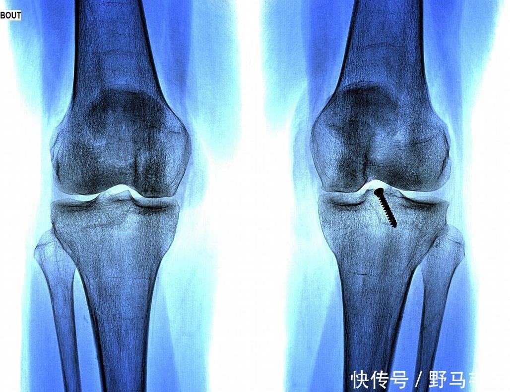 结果|9岁男孩骨骼线完全闭合,检查结果出来后,家长引咎自责