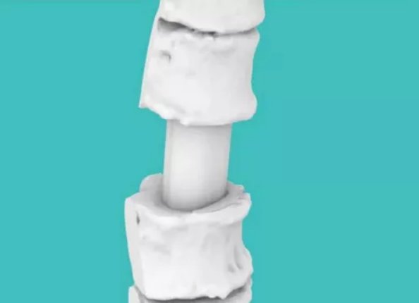 椎体|烟台山医院成功完成全脊柱肿瘤切除＋3D打印人工椎体置换术