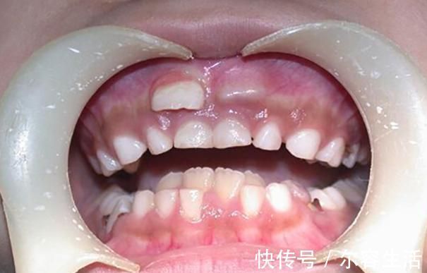 何丽|越来越多孩子长“双排牙”,与糖果无关,是父母喂养有误区