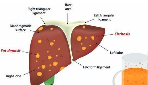  别等|喝酒后出现四个“破绽”，尽早去检查肝脏，别等肝硬化进展为肝癌