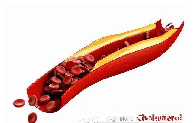低密度脂蛋白胆固醇|吃得清淡也不胖，怎么血脂还高了？详解引起高血脂的8种原因