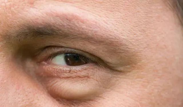 猪腰子|42岁男子腰疼入院,查出肾衰竭,提醒:餐桌上一道“菜”最好少吃