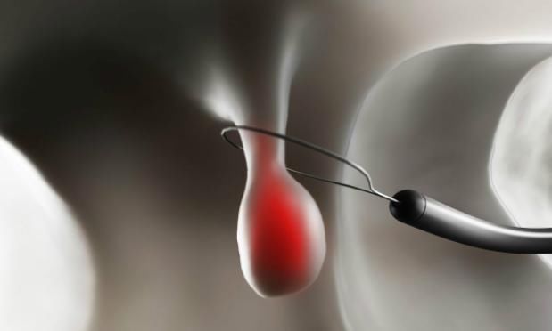 老戴|有三种息肉最好及时切除,拖延太久就会变成恶性肿瘤!你清楚吗?