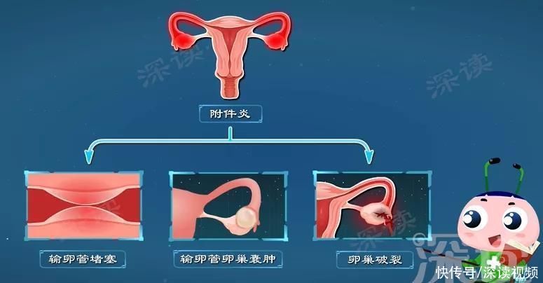 小姐姐|下腹持续隐痛？白带增多有异味？导致不孕的附件炎到底是啥样？