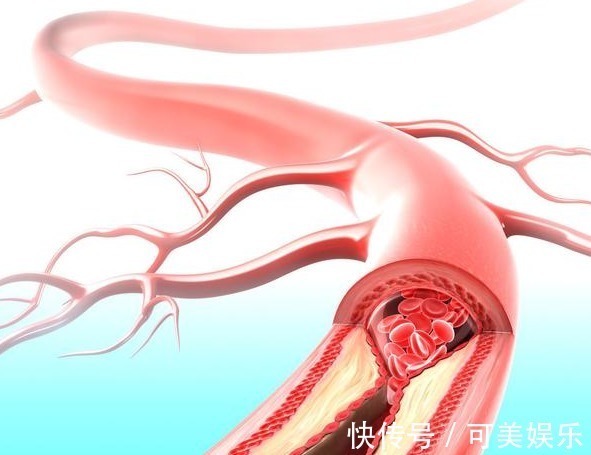 高血脂|98岁中医,血管再堵,用对这个方法,快速解决高血脂,用1个好1个