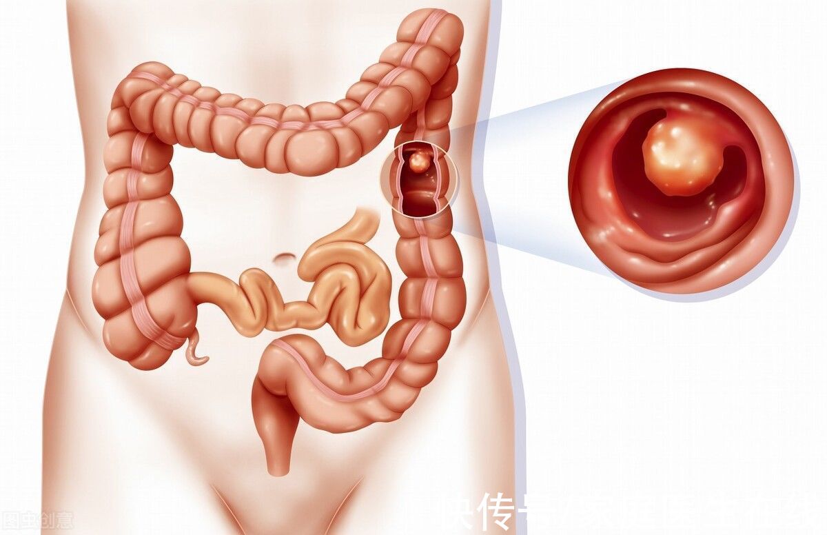 肠道痉挛|肠道这5种病变都是身体难以承受的，3个习惯，更好地保护肠道