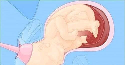 第三产程|顺产宝宝是怎么“生”的一组图带你了解全过程，妈妈其实不孤单