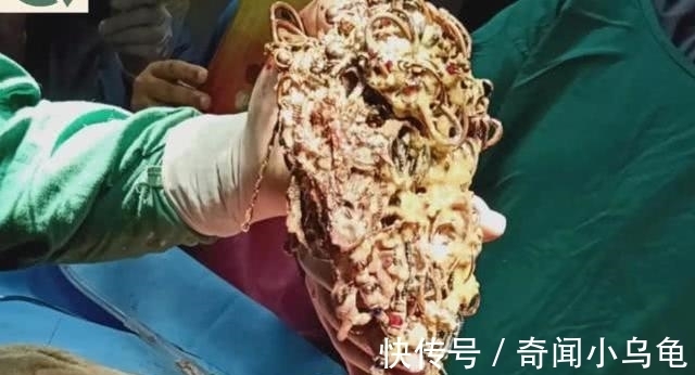 比斯瓦斯|印度一女子身体里竟取出价值45万的珠宝:69条链子,80个耳环