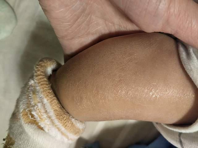 嘴皮|孩子嘴唇起皮,妈妈想尽方法都不管用?都是“手欠”惹的祸