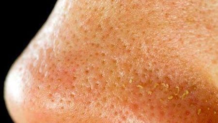 现象|三种现象证明你脸上长了螨虫,还在用醋洗脸吗,难怪没效果