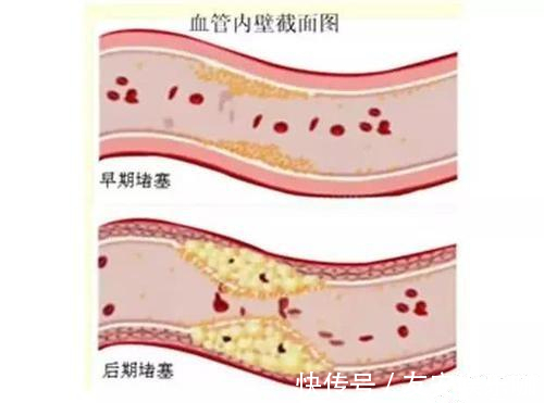 脑梗死|80岁老人,血管年龄仅有30岁!他的保养秘诀是什么?