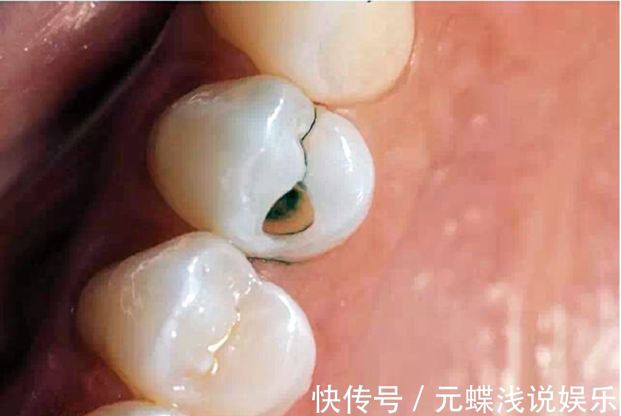 宝宝|好不容易等到宝宝换牙期,新牙却长歪了?医生:家长无知惹得锅