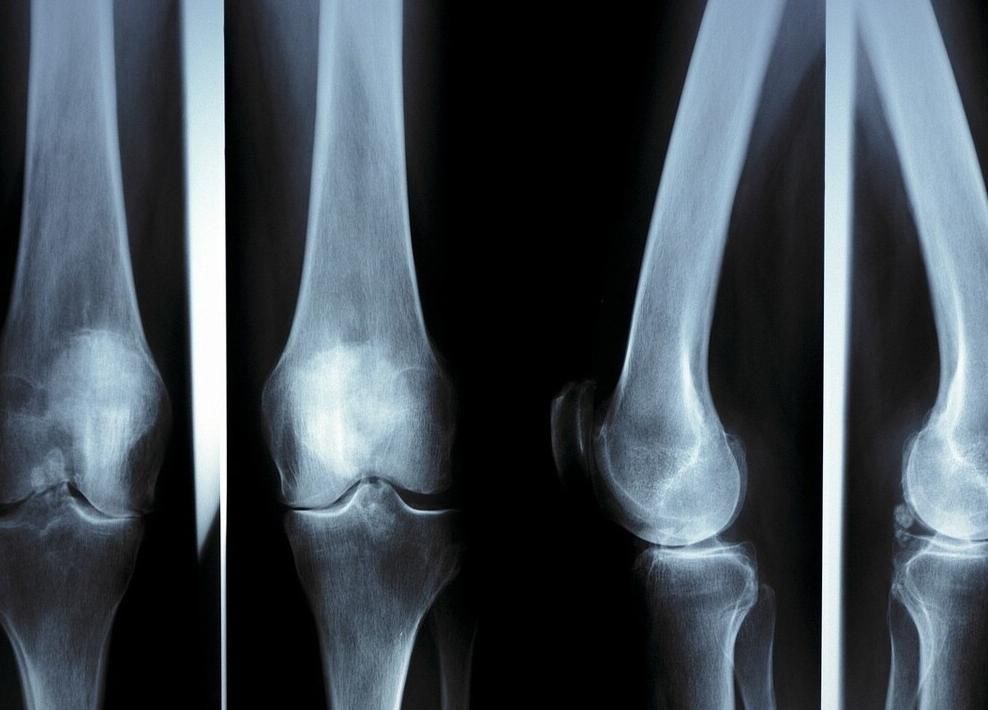 骨骼|8岁男孩饮食丰富,却不见长个,3种“偷走”身高的食物要少吃