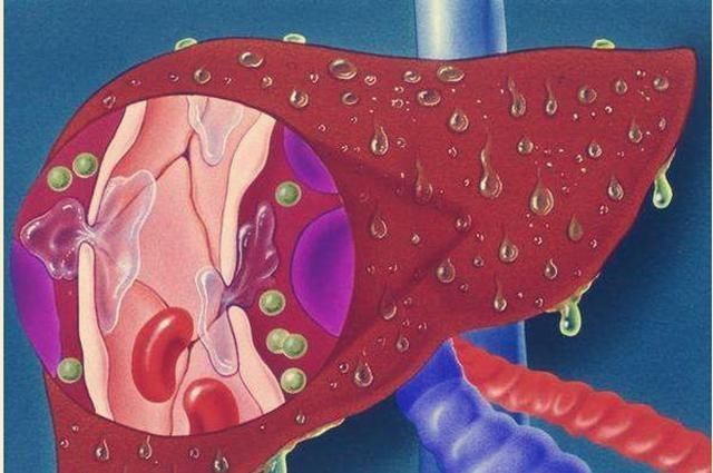 t22岁妹子罹患肝癌，医生建议肝移植，妹子思考良久：不做！